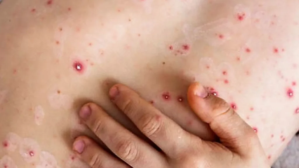 ¿Qué es el virus Mpox (viruela del mono) y cómo se contagia?