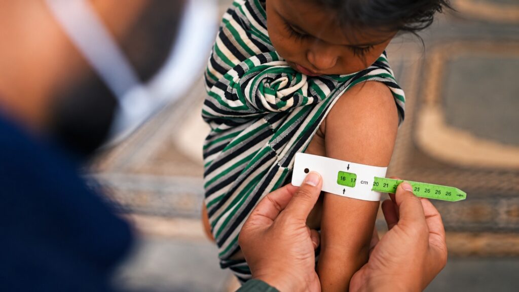 Desnutrición crónica infantil afecta al 15% de los niños menores de cinco años en Piura Desnutrición crónica infantil afecta al 15% de los niños menores de cinco años en Piura